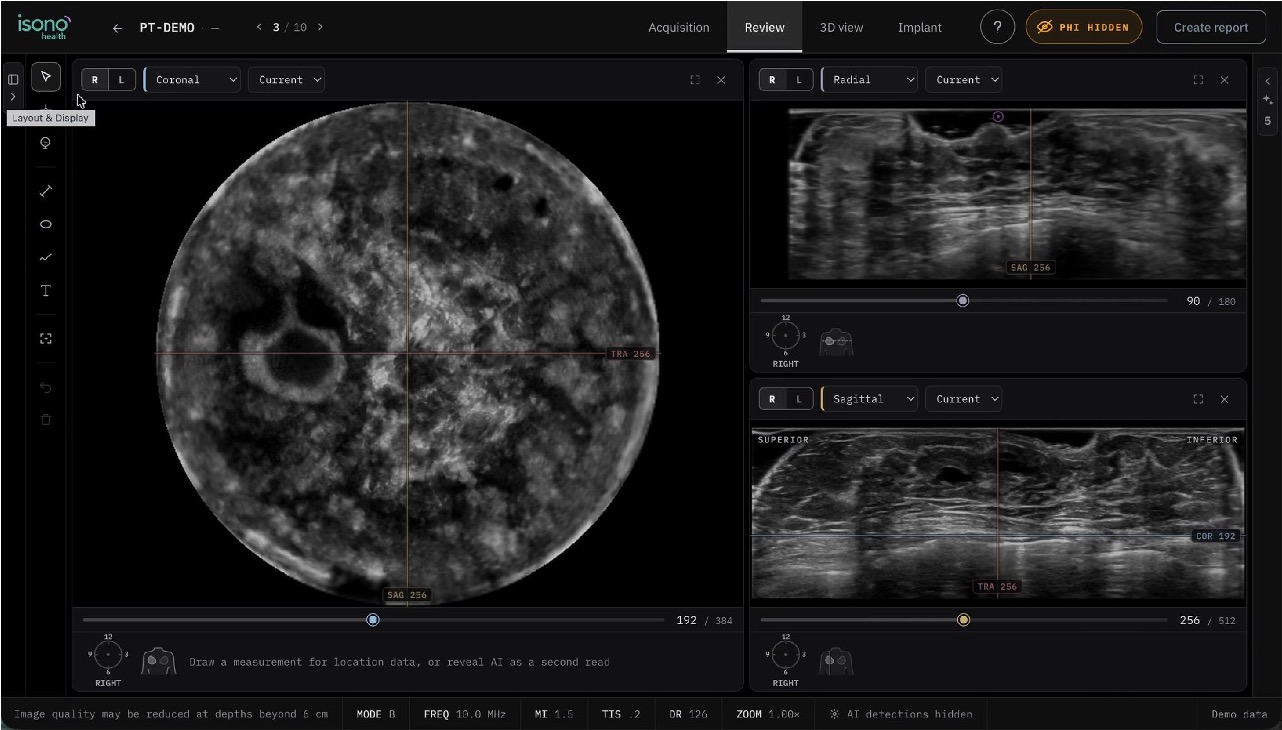IA câncer mama em visualização do sistema iSono Health ATUSA