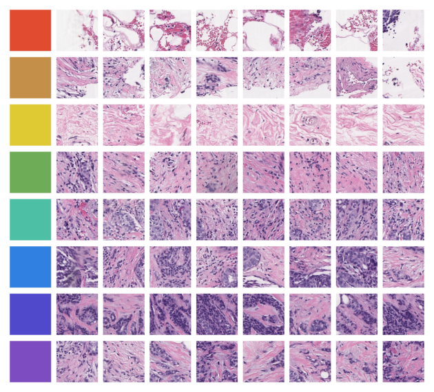IA câncer mama em clusters coloridos de lâminas de patologia da Ataraxis